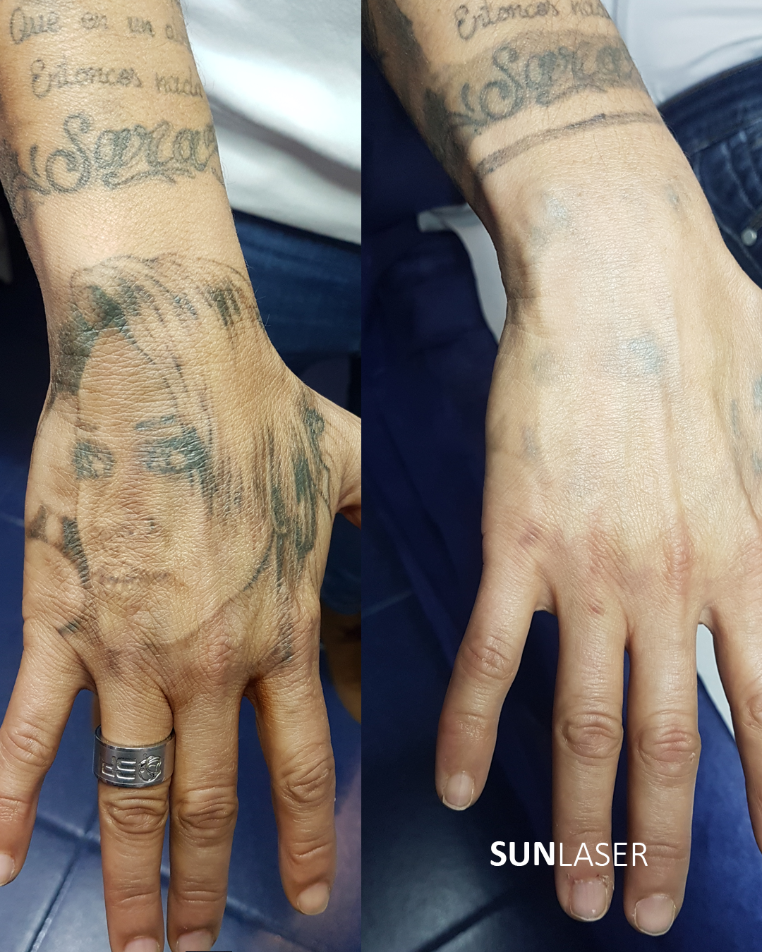 antes-y-despues-mano