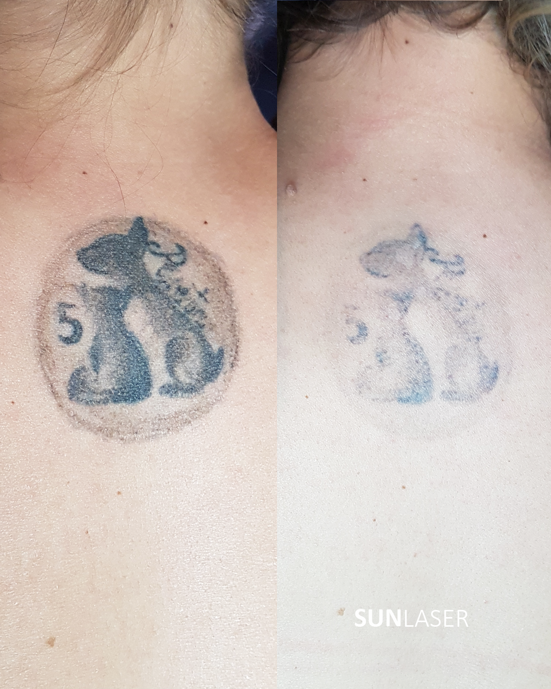 eliminacion-tattoos-antes-y-despues
