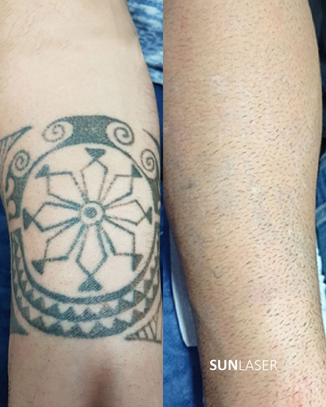 Eliminacion-de-Tatuajes-Valencia,-1