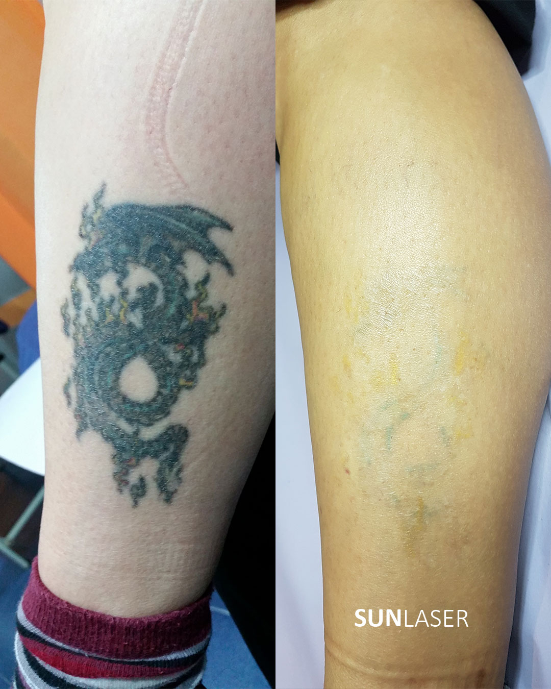 Eliminacion-de-Tatuajes-Valencia,-2