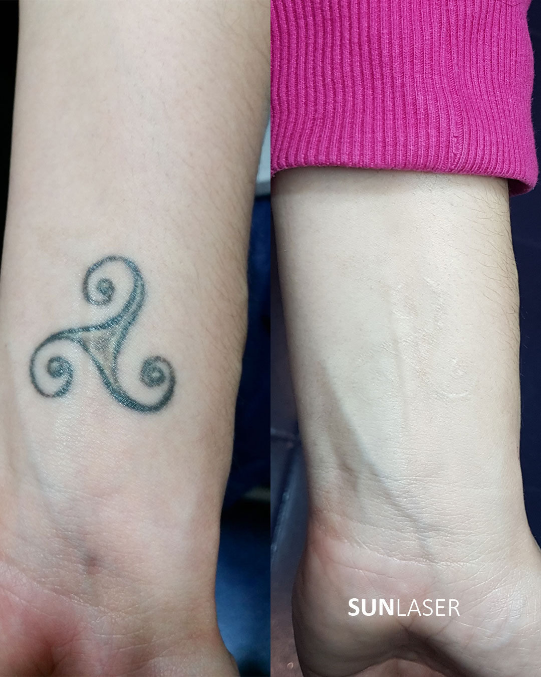 Eliminacion-de-Tatuajes-Valencia,11