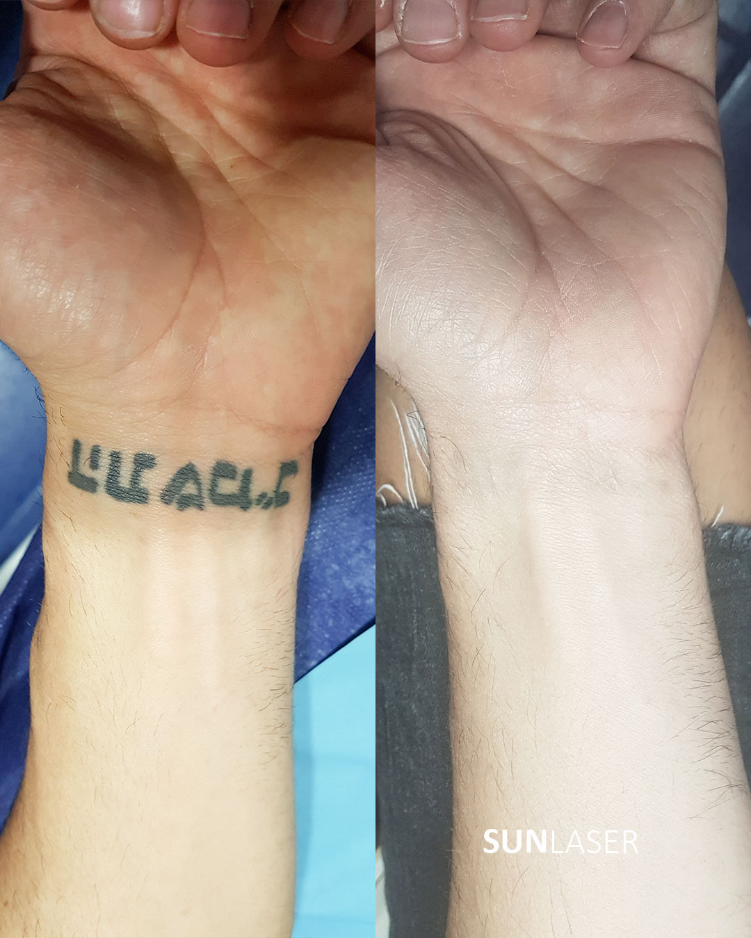 Eliminacion-de-Tatuajes-Valencia,12