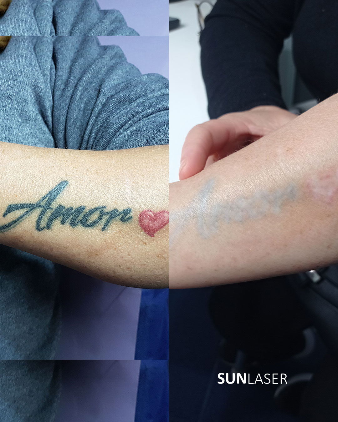Eliminacion-de-Tatuajes-Valencia,13