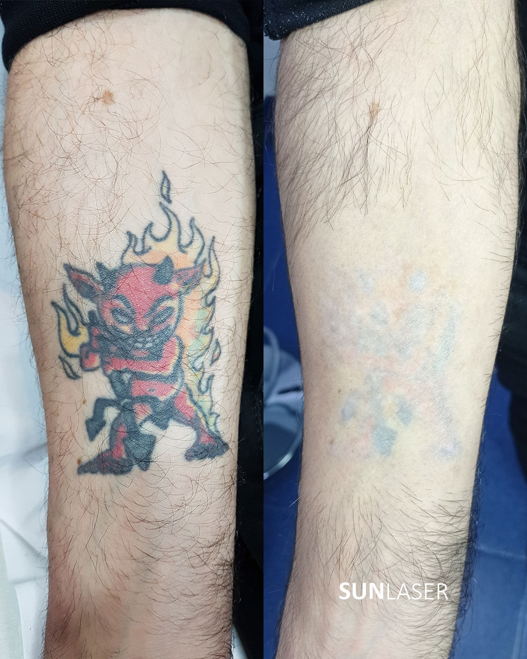 Eliminacion-de-Tatuajes-Valencia,14