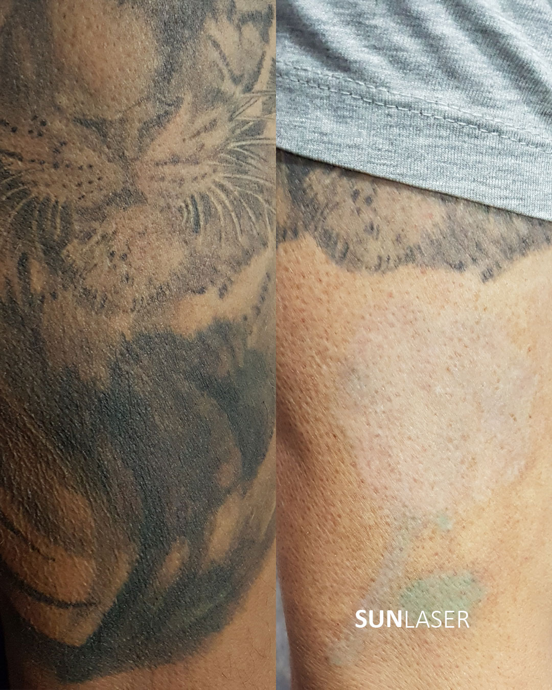 Eliminacion-de-Tatuajes-Valencia,15