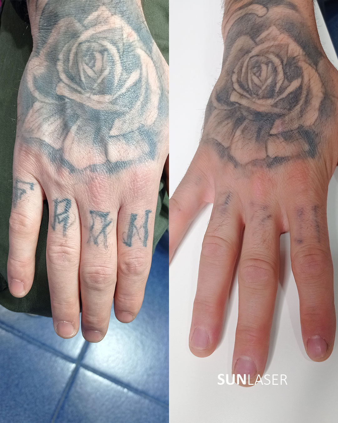 Eliminacion-de-Tatuajes-Valencia,16