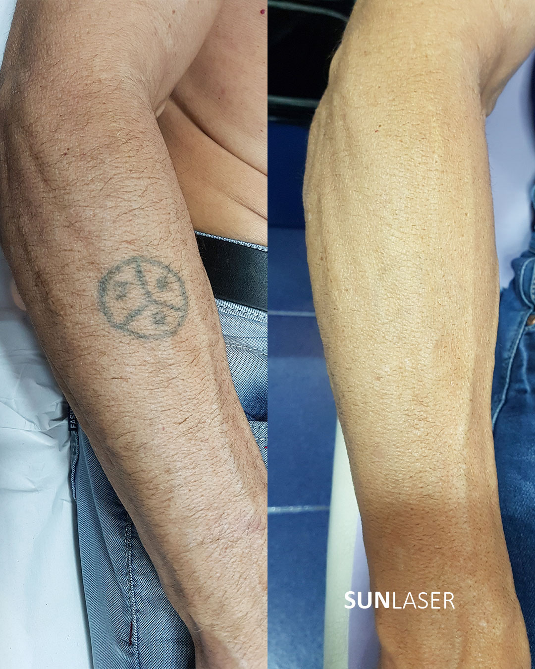 Eliminacion-de-Tatuajes-Valencia,18