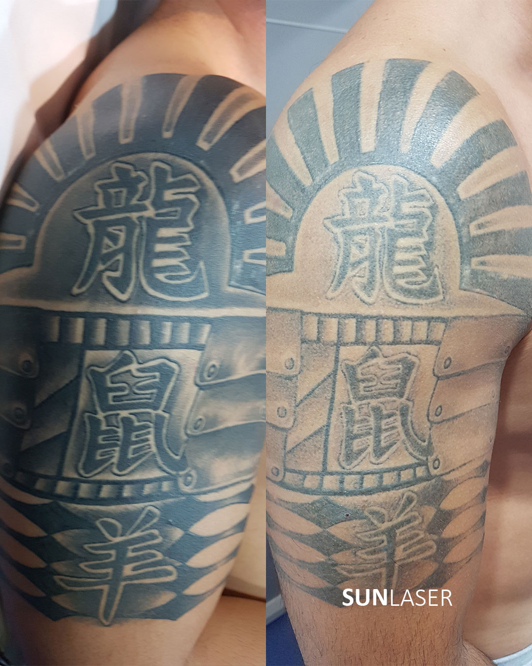 Eliminacion-de-Tatuajes-Valencia,19