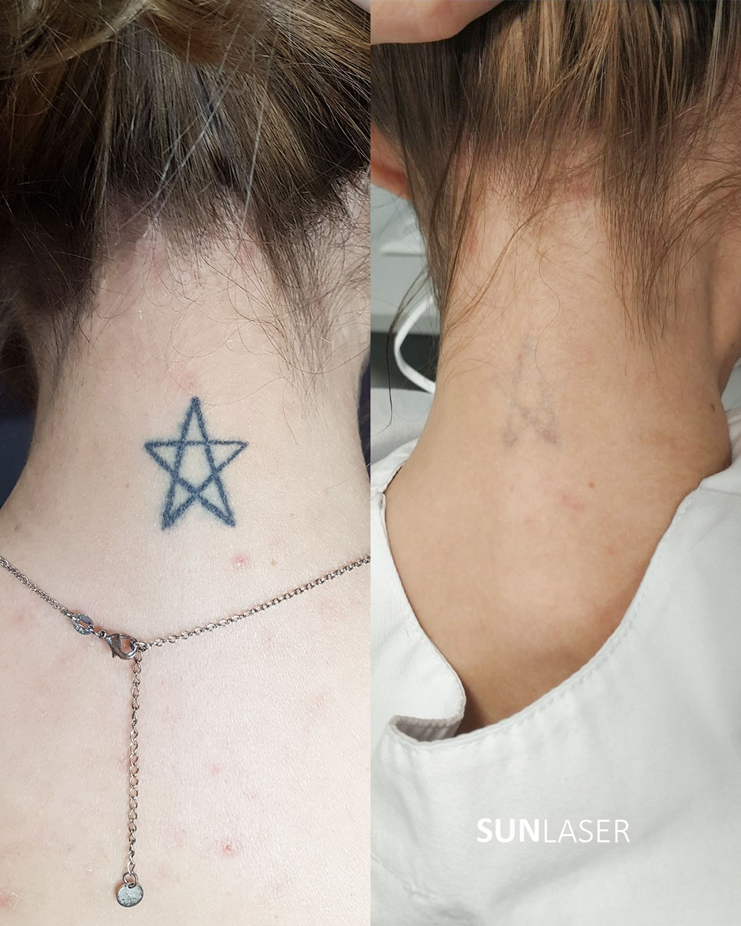 Eliminacion-de-Tatuajes-Valencia,20