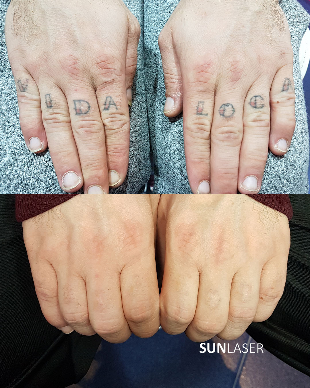 Eliminacion-de-Tatuajes-Valencia,21