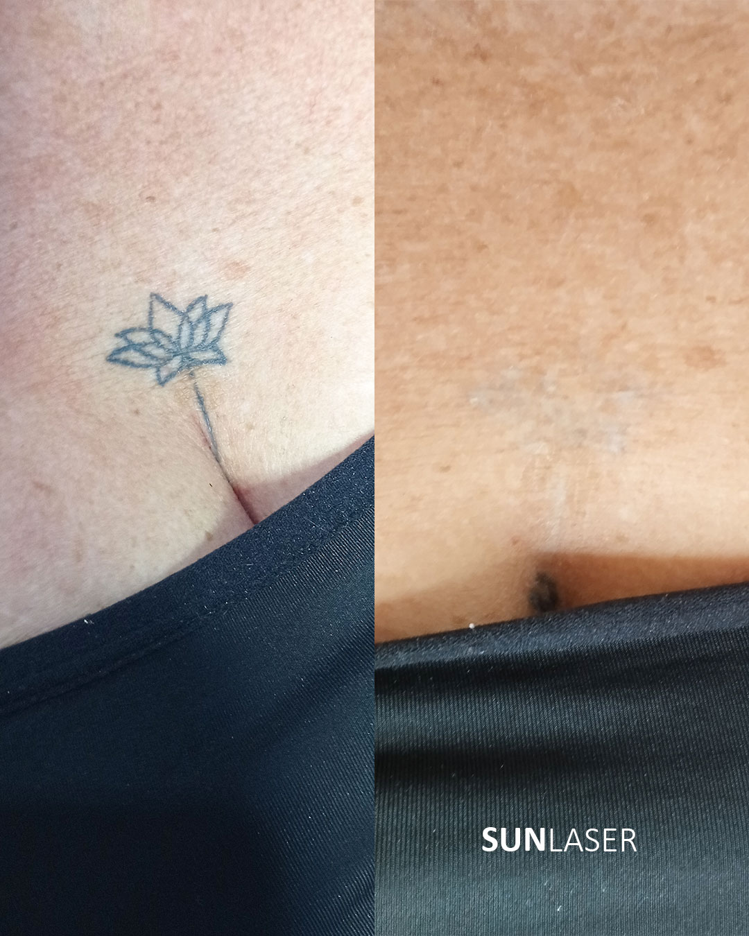 Eliminacion-de-Tatuajes-Valencia,22