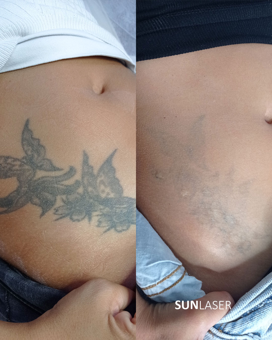 Eliminacion-de-Tatuajes-Valencia,23