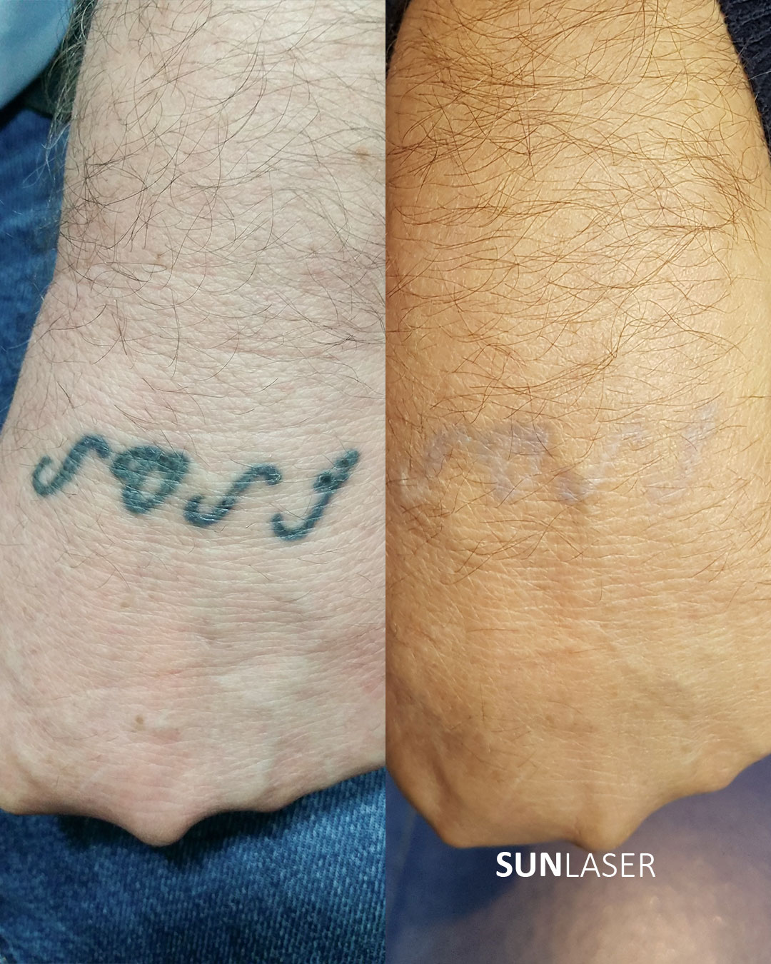 Eliminacion-de-Tatuajes-Valencia,25