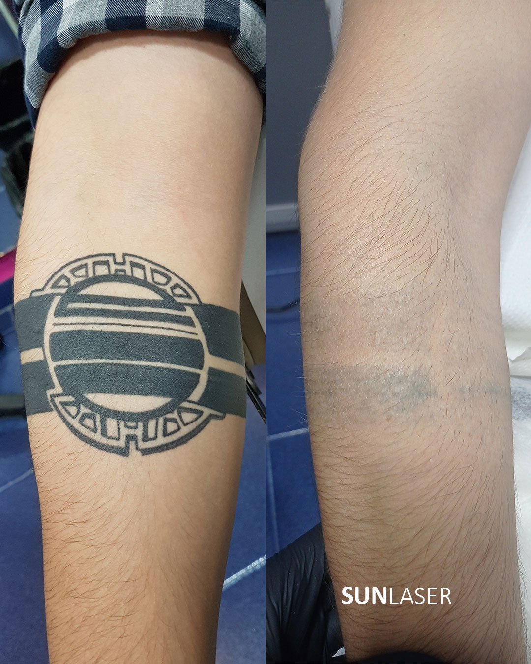 Eliminacion-de-Tatuajes-Valencia,26