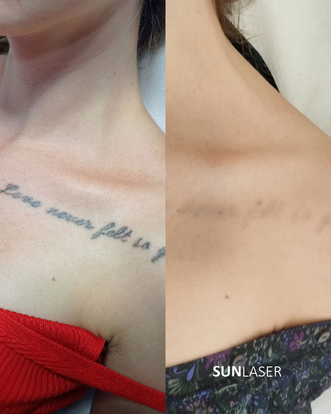 Eliminacion-de-Tatuajes-Valencia,27