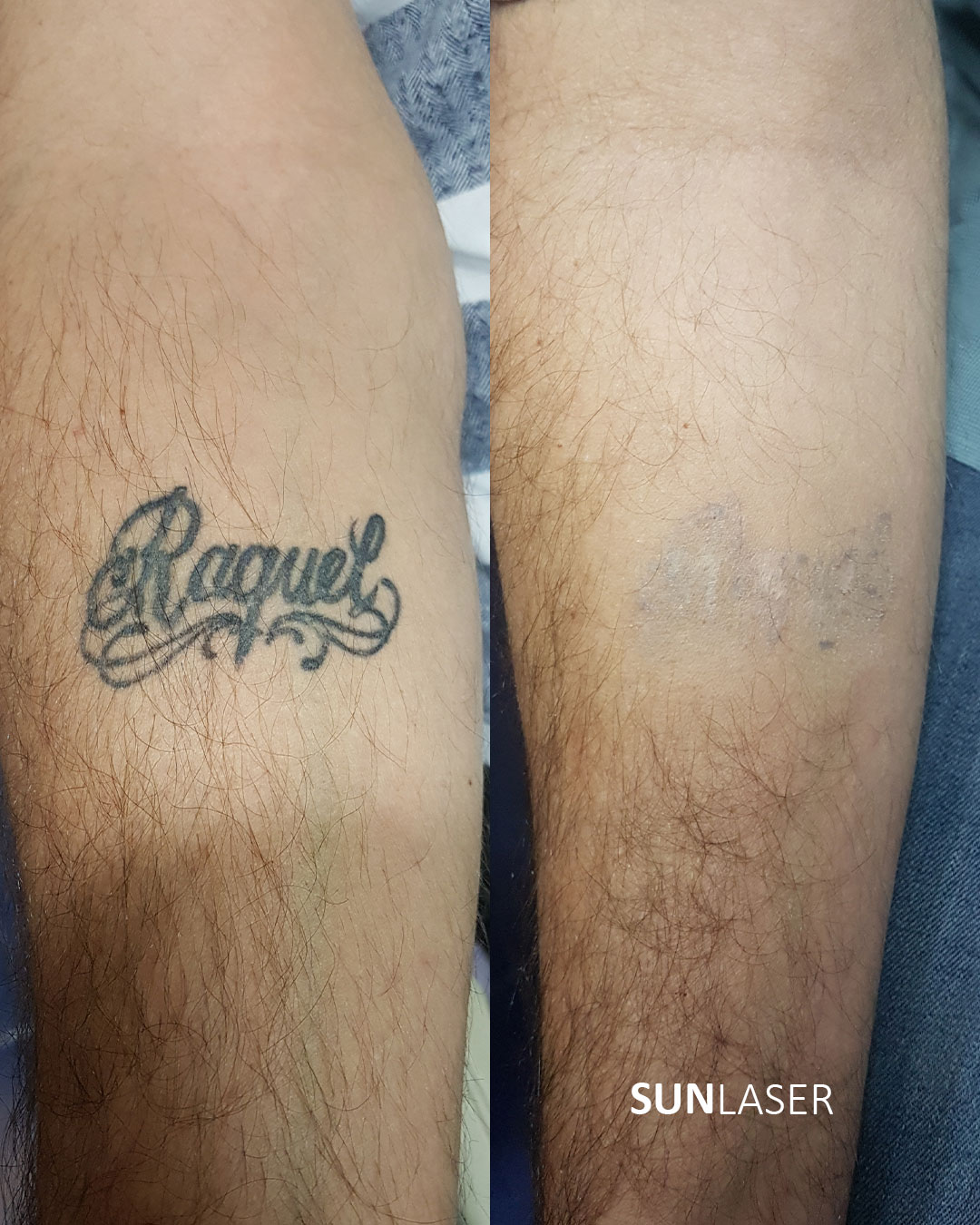 Eliminacion-de-Tatuajes-Valencia,28