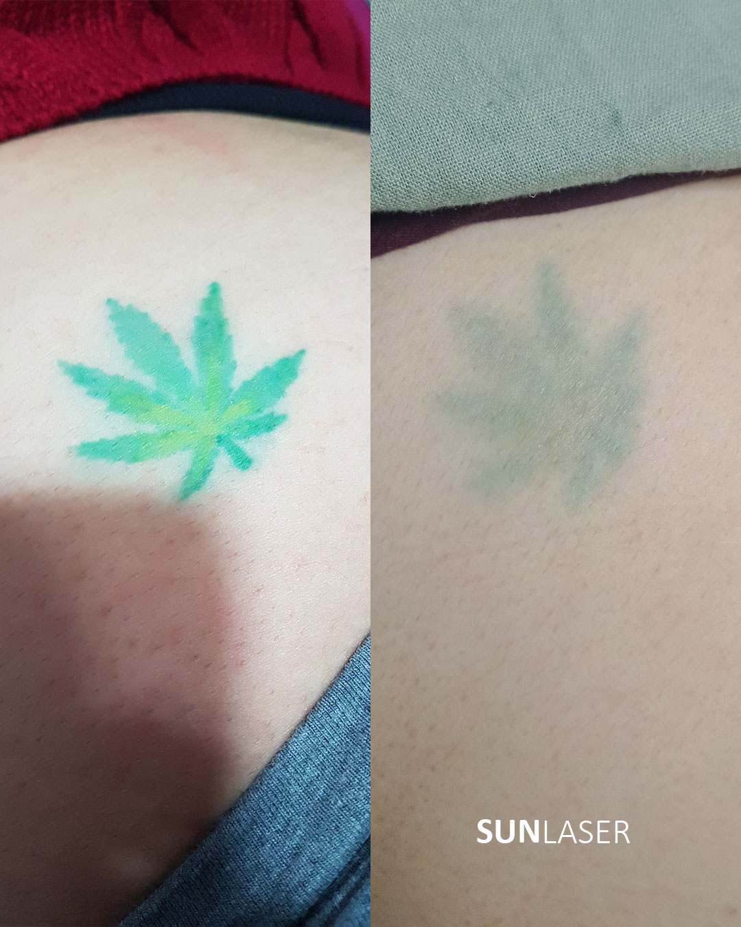 Eliminacion-de-Tatuajes-Valencia,29