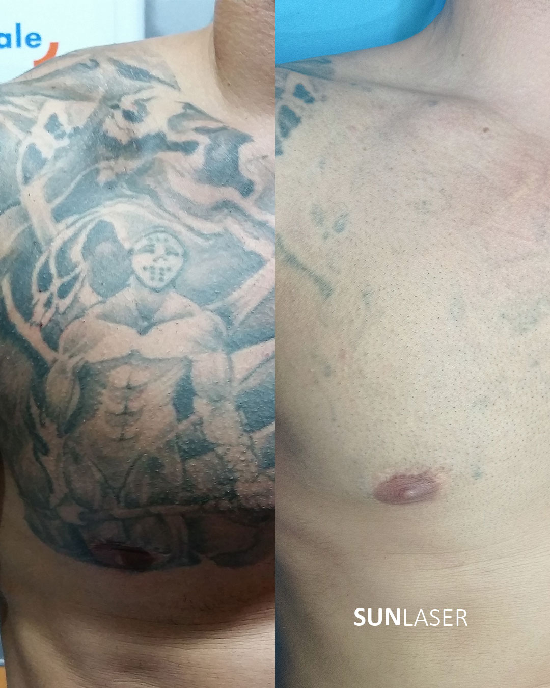 Eliminacion-de-Tatuajes-Valencia,3