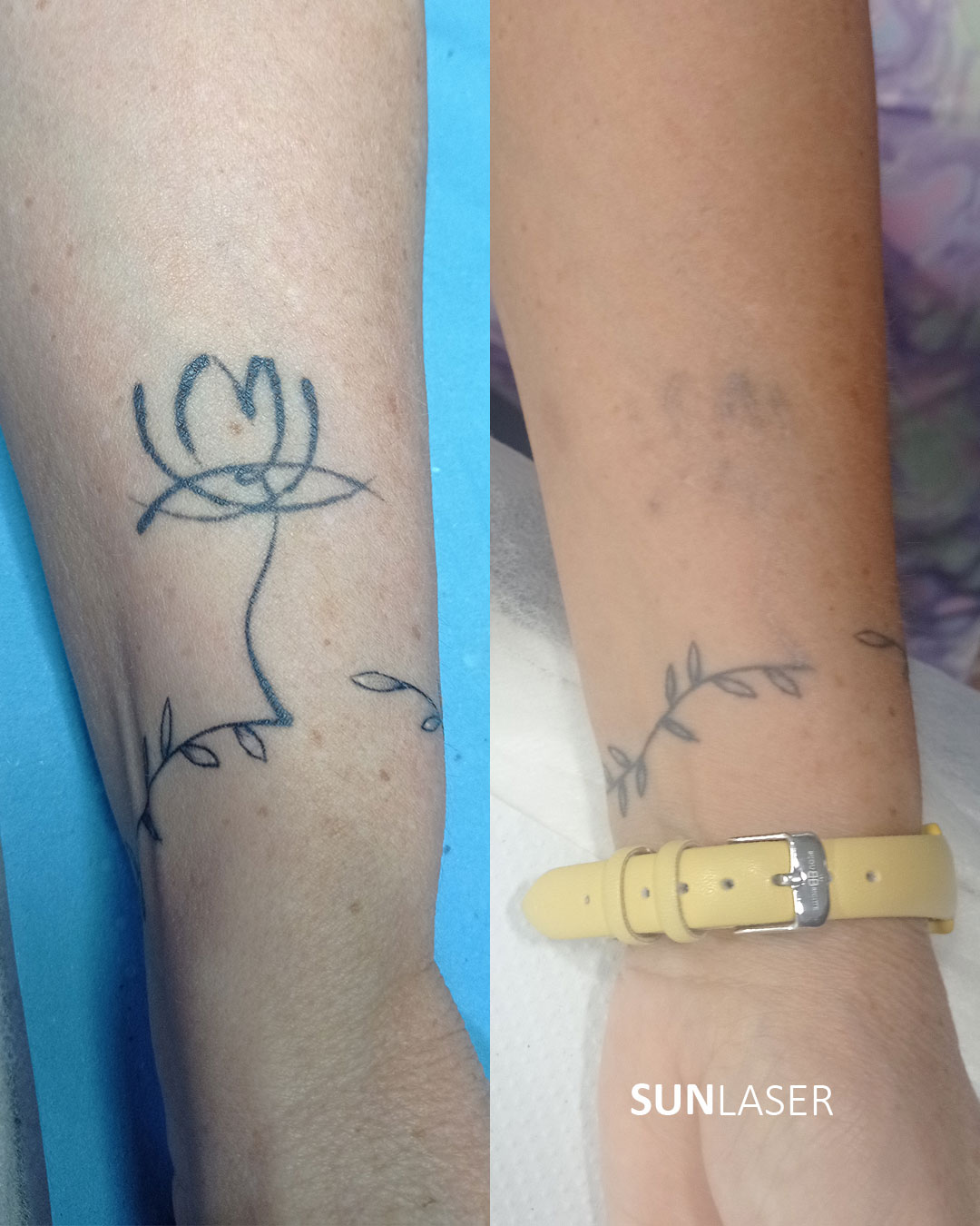 Eliminacion-de-Tatuajes-Valencia,30