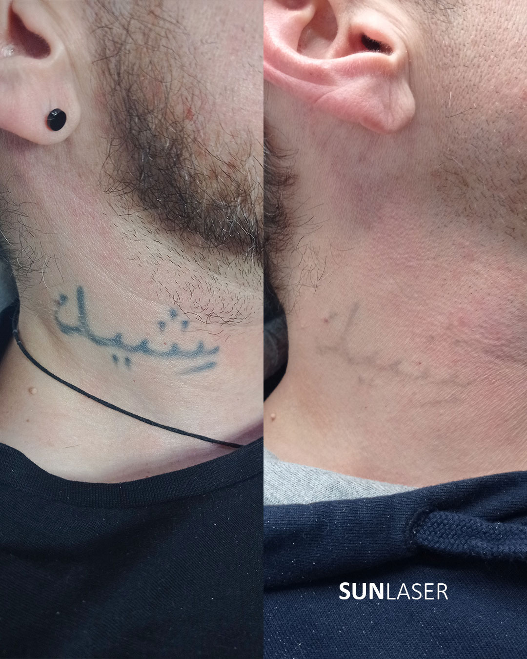 Eliminacion-de-Tatuajes-Valencia,31