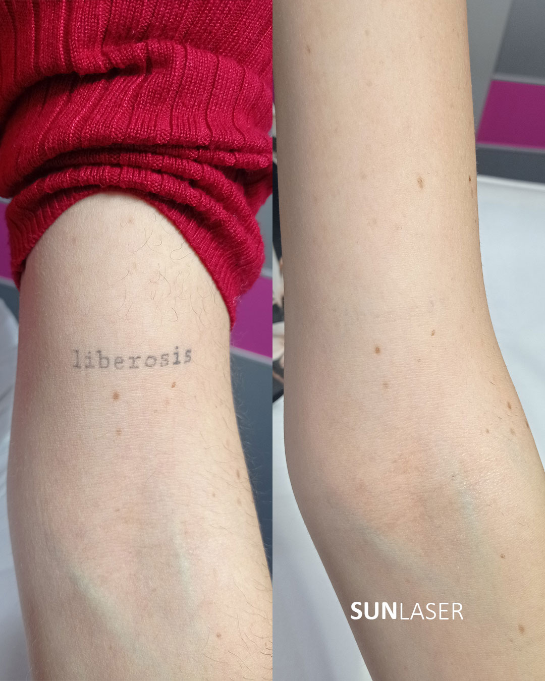 Eliminacion-de-Tatuajes-Valencia,32