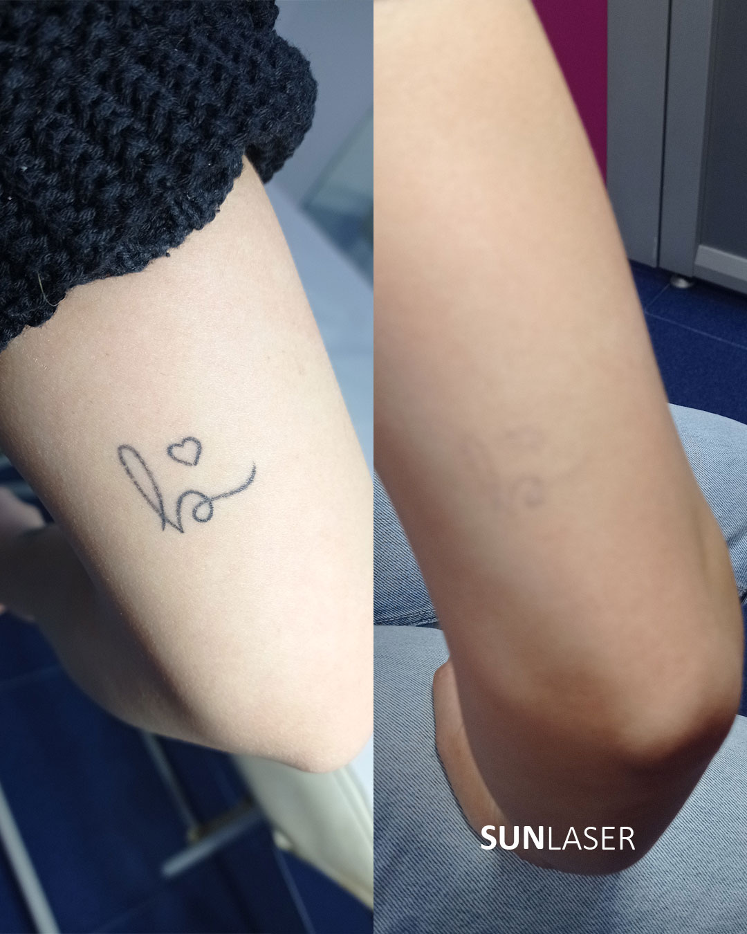 Eliminacion-de-Tatuajes-Valencia,33