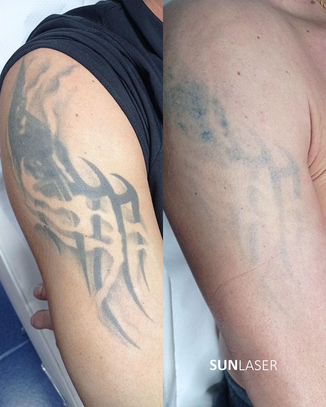 Eliminacion-de-Tatuajes-Valencia,34