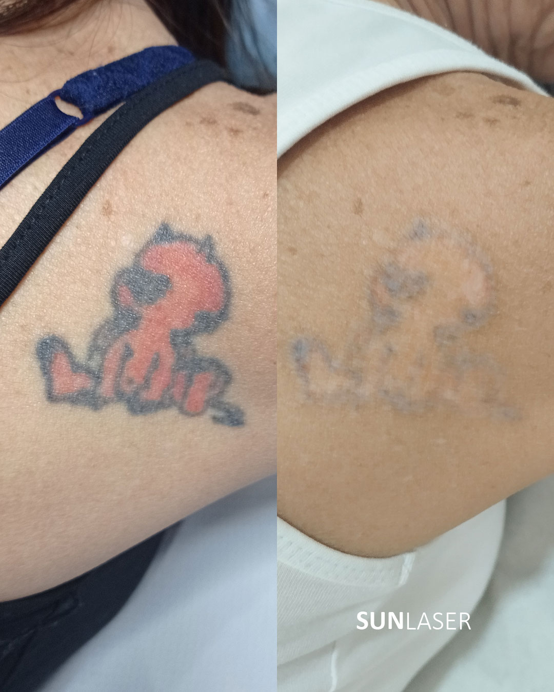 Eliminacion-de-Tatuajes-Valencia,35
