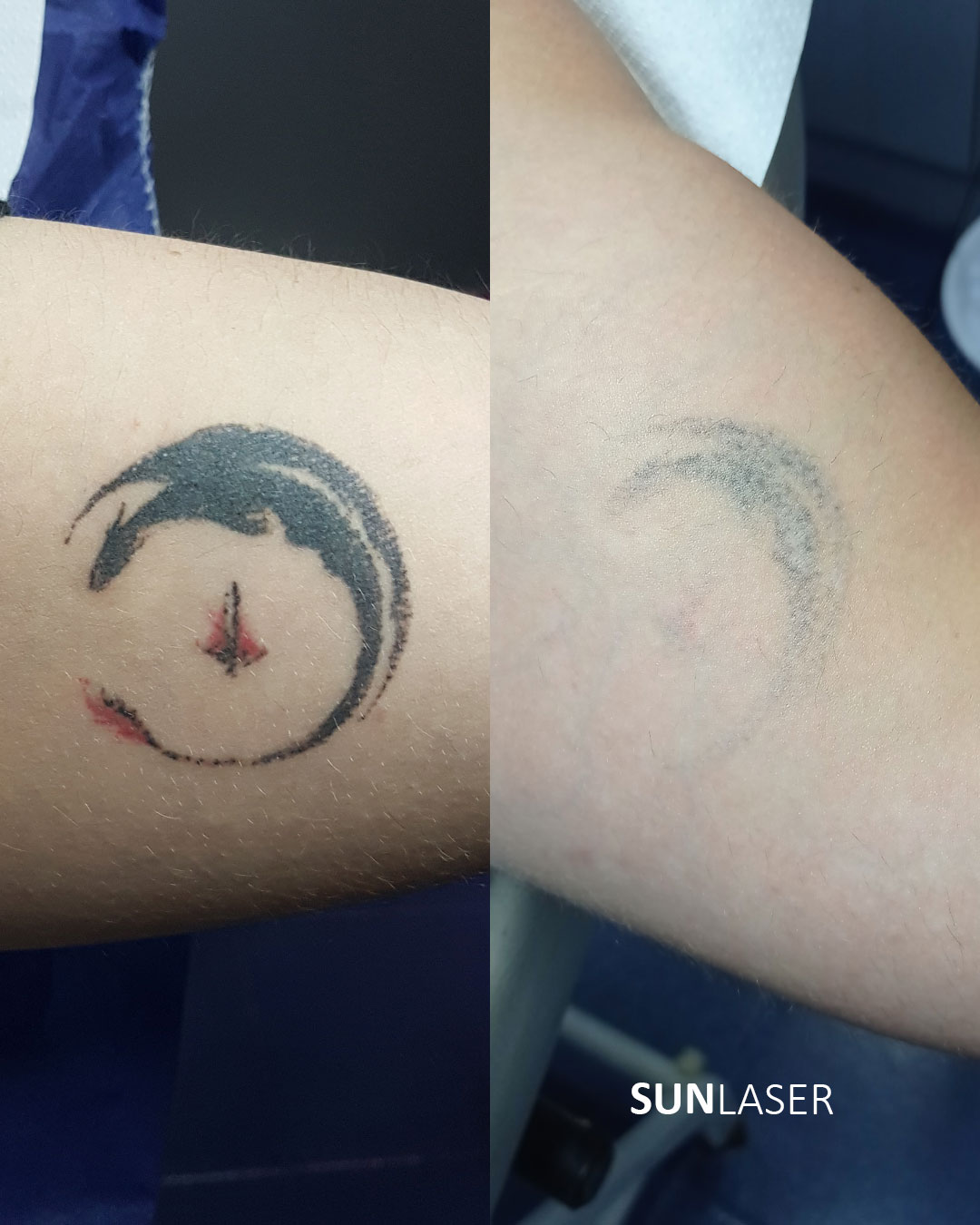 Eliminacion-de-Tatuajes-Valencia,36