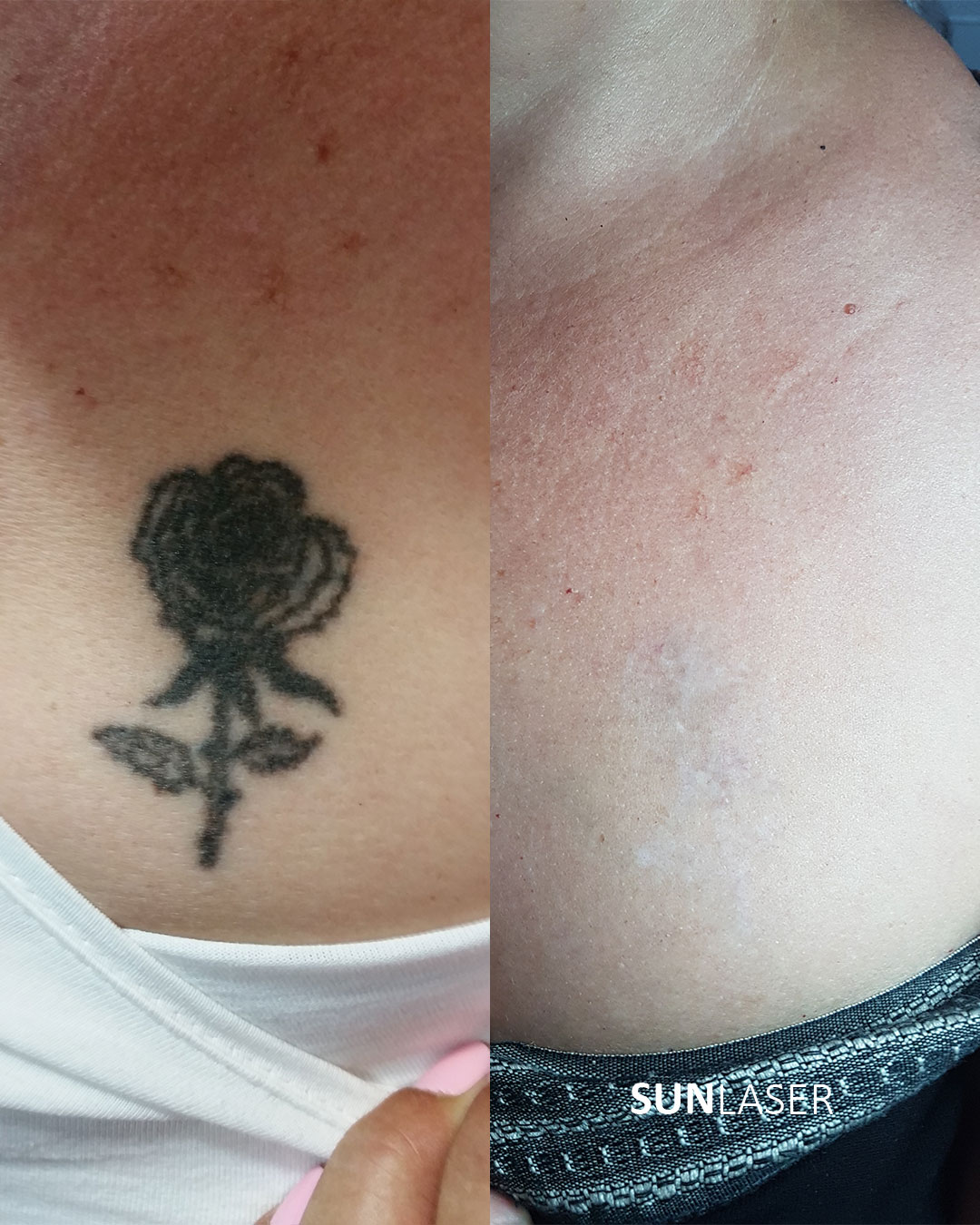 Eliminacion-de-Tatuajes-Valencia,4