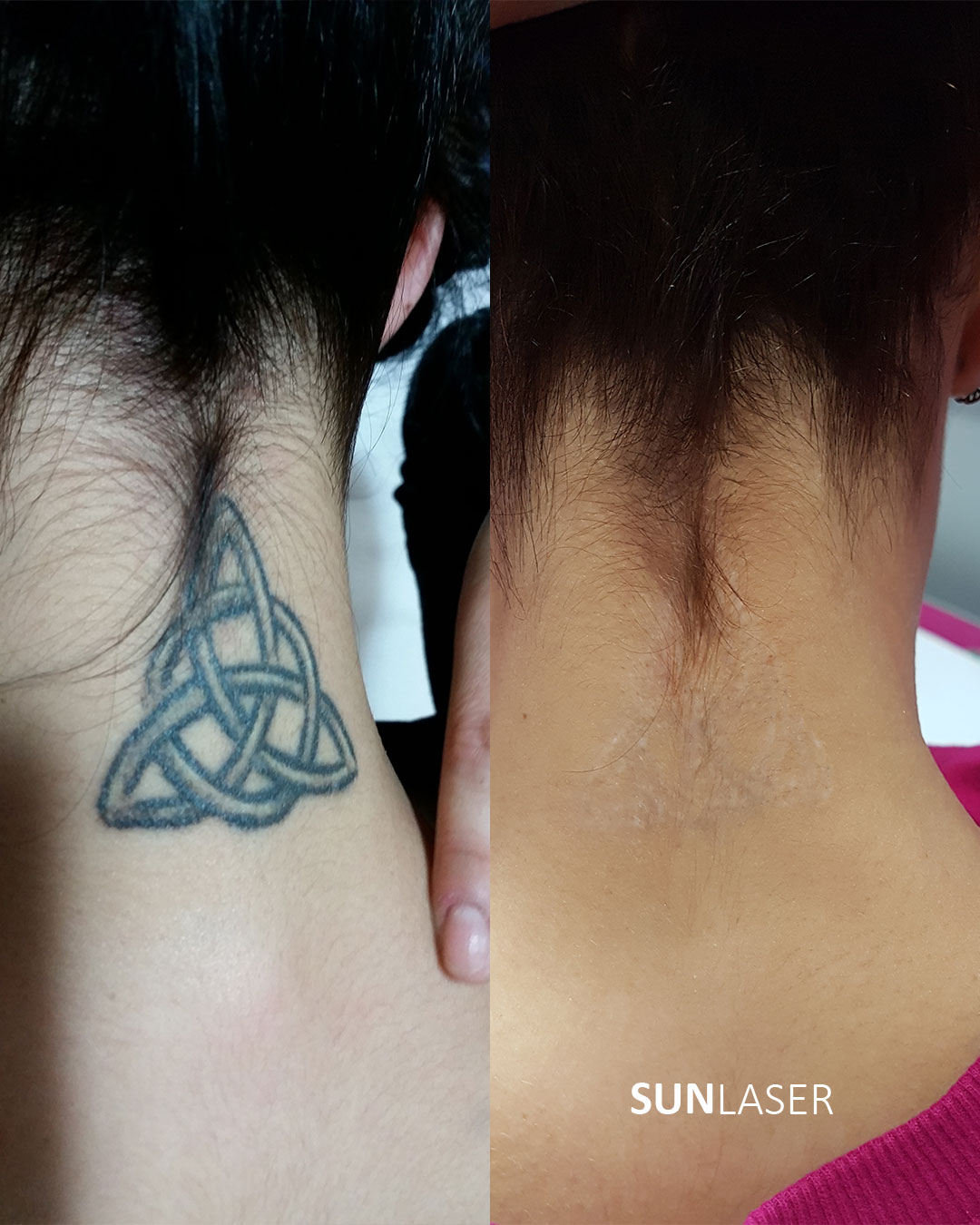 Eliminacion-de-Tatuajes-Valencia,5