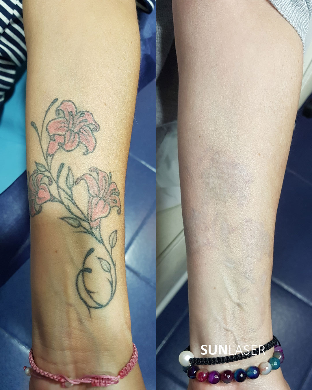 Eliminacion-de-Tatuajes-Valencia,7