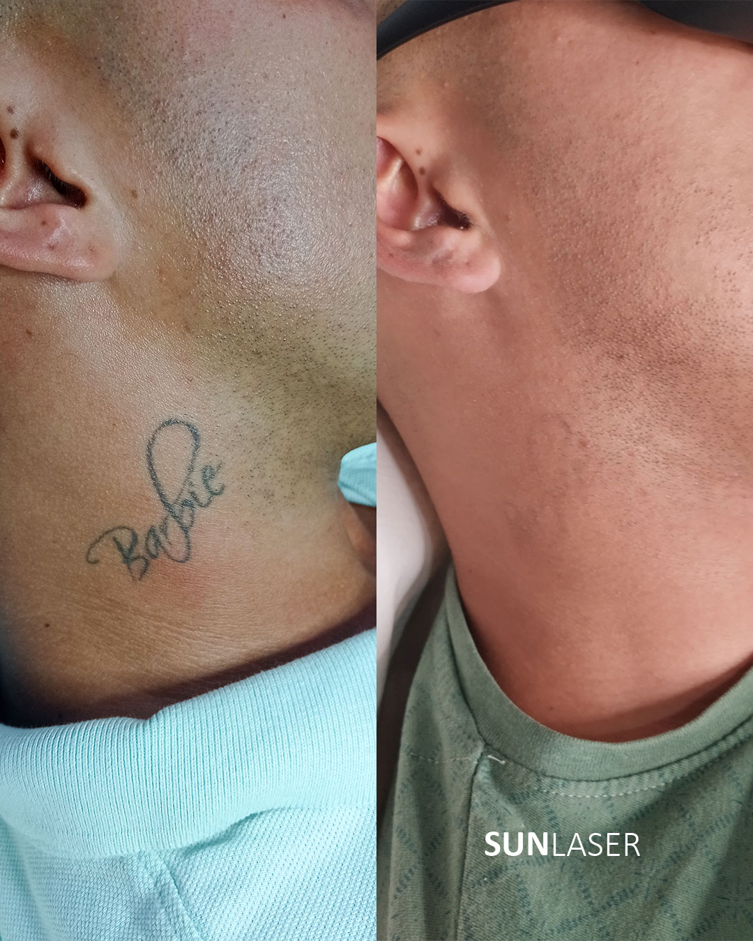 Eliminacion-de-Tatuajes-Valencia,8