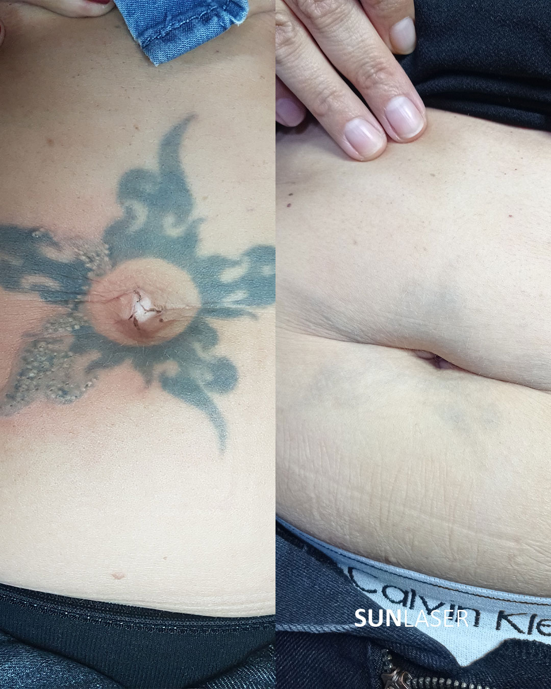 Eliminacion-de-Tatuajes-Valencia,9